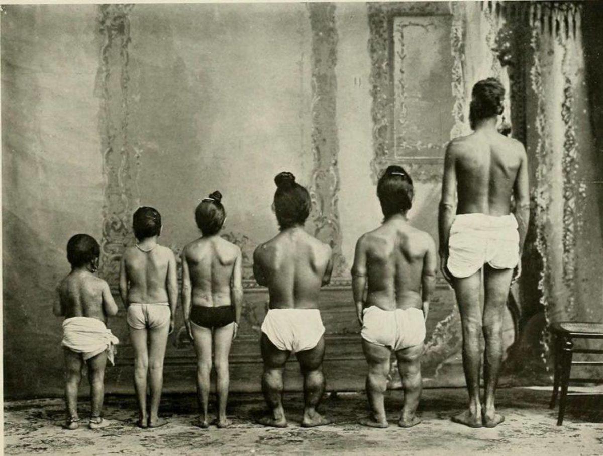 Akraba Evlilikleri Yüzünden Ortaya Çıkmış 10 Genetik Mutasyon!