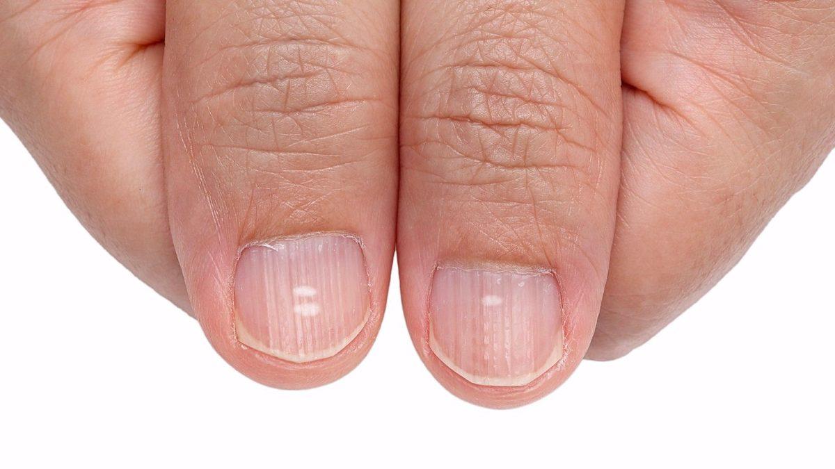 Tırnaklarımızda Oluşan Bu Beyaz Lekeler Ne Anlama Geliyor?