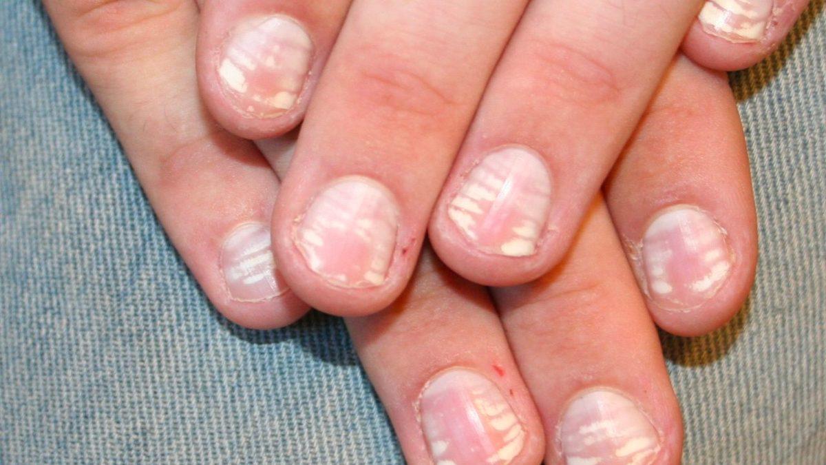 Tırnaklarımızda Oluşan Bu Beyaz Lekeler Ne Anlama Geliyor?