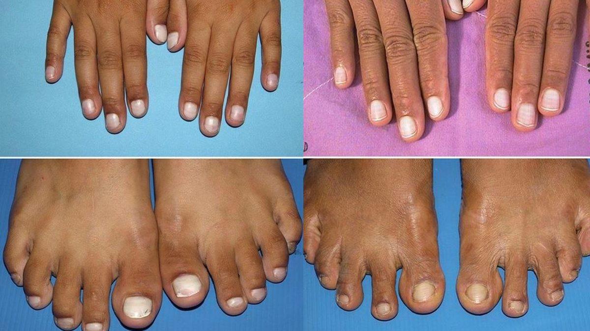 Tırnaklarımızda Oluşan Bu Beyaz Lekeler Ne Anlama Geliyor?