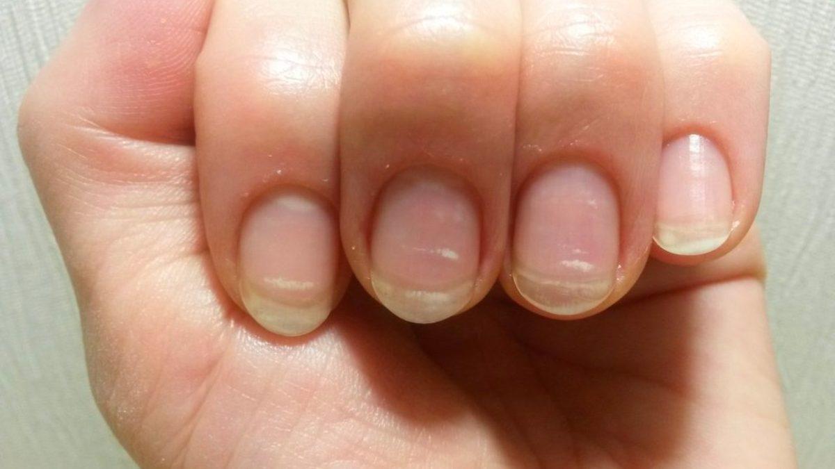 Tırnaklarımızda Oluşan Bu Beyaz Lekeler Ne Anlama Geliyor?