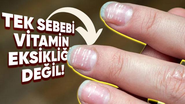Tırnaklarımızda Oluşan Bu Beyaz Lekeler Ne Anlama Geliyor?