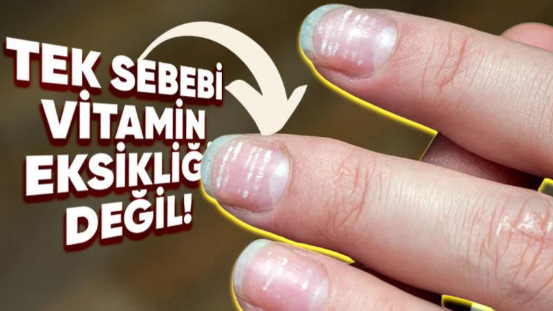 Tırnaklarımızda Oluşan Bu Beyaz Lekeler Ne Anlama Geliyor?