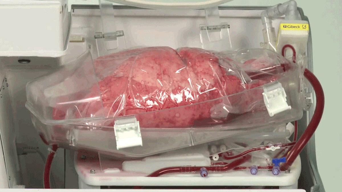 Ülkemizde İlk Kez Bir Kanser Hastasına Akciğer Nakli Yapıldı!