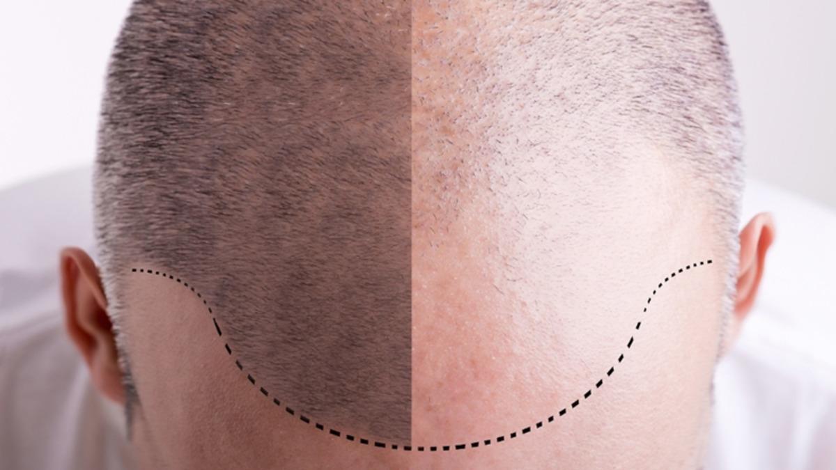 Bilim İnsanları Kelliğin Sebebini Buldu!