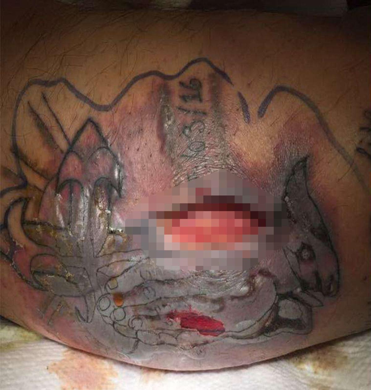 Dövme Yaptırdıktan Sonra Denize Giren Adam, ’Et Yiyen Bakteriler’ Nedeniyle Hayatını Kaybetti (+18)