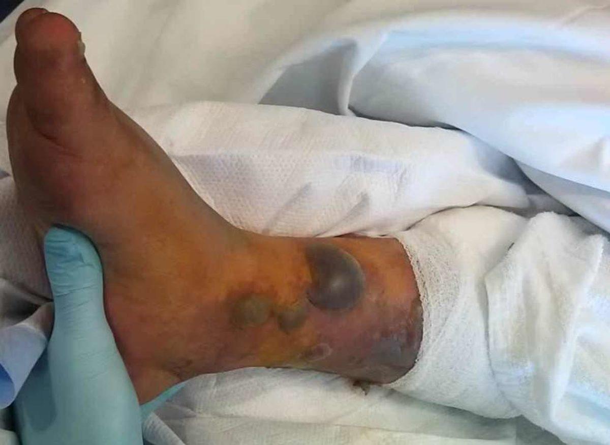 Dövme Yaptırdıktan Sonra Denize Giren Adam, ’Et Yiyen Bakteriler’ Nedeniyle Hayatını Kaybetti (+18)