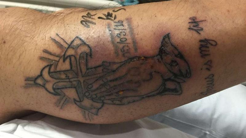 Dövme Yaptırdıktan Sonra Denize Giren Adam, ’Et Yiyen Bakteriler’ Nedeniyle Hayatını Kaybetti (+18)